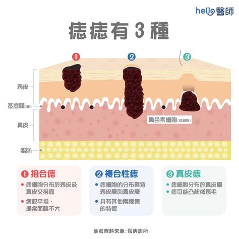 長痣 原因